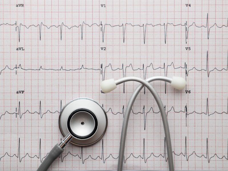 como é feito eletrocardiograma e registro