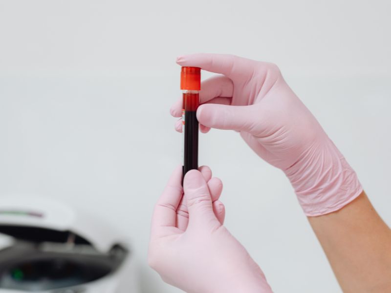 para que serve o exame lipoproteína a